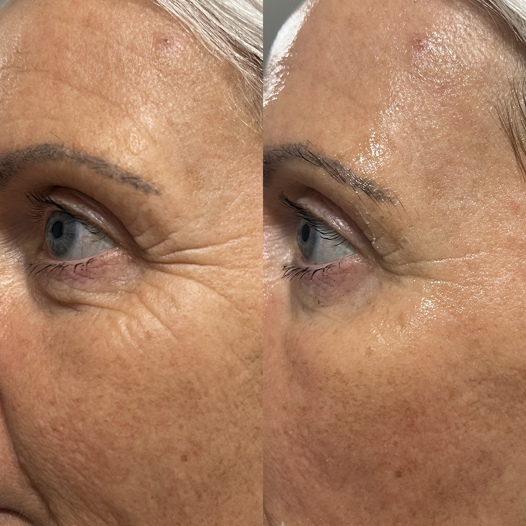 NUKO® Karboksyterapia